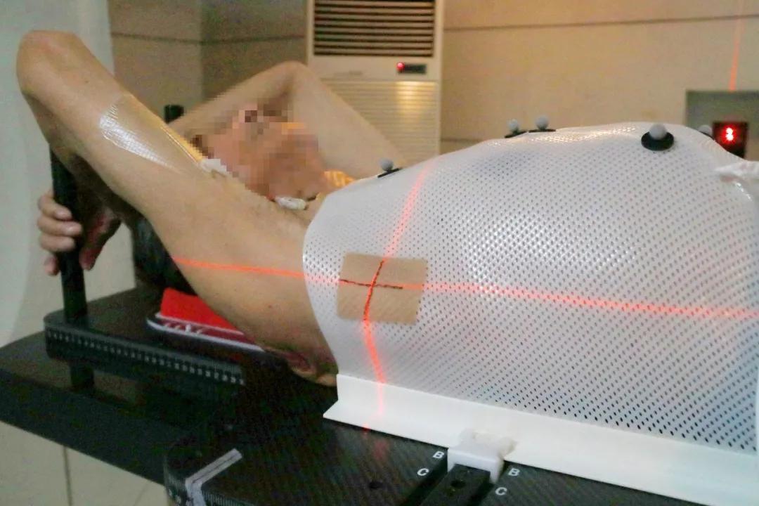 放疗新技术精准,精准杀灭癌细胞