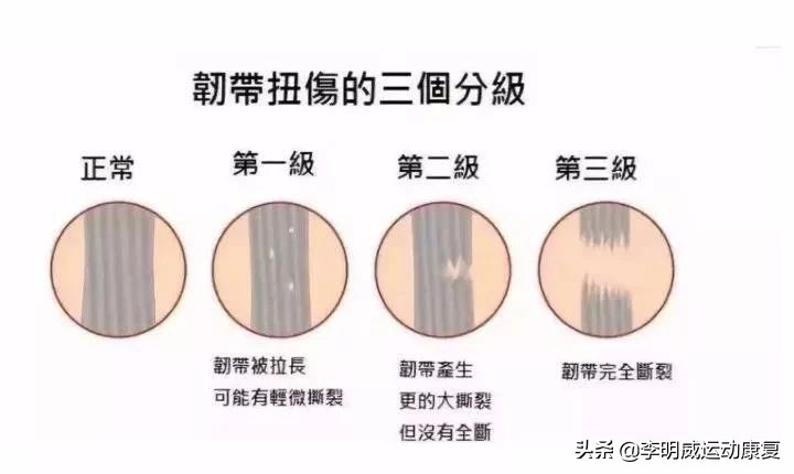 轻度脚踝扭伤的处理方法及康复,脚踝扭伤康复训练6种简单方法