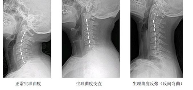 颈椎曲度没问题会椎间盘突出么,正常的颈椎曲度是什么样的