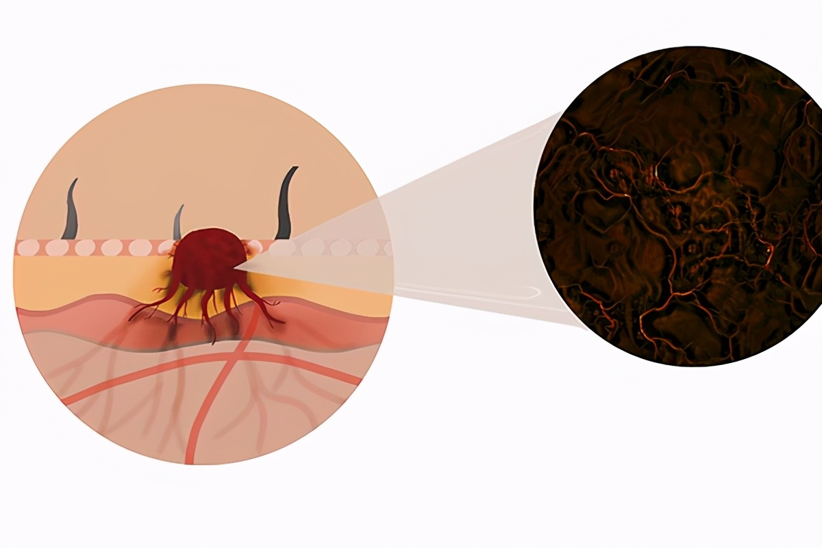 为什么癌细胞扩散了救不活,扩散的癌细胞还会继续扩散吗