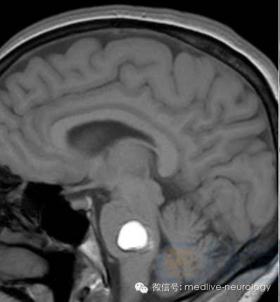脑出血磁共振t1t2表现,10分钟记住脑出血核磁表现