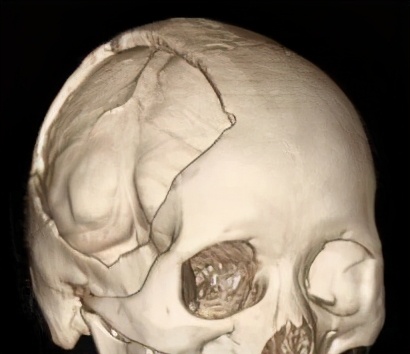 颅骨缺损修补的护理目标,颅骨缺损修补后还算缺损吗