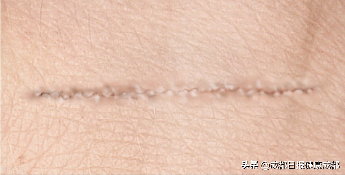 如何抚平烧伤疤痕,怎么去除厚厚的烧伤疤痕增生