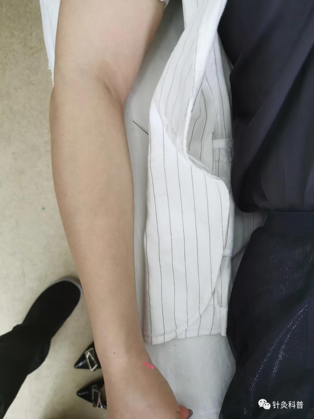 针灸后偏头痛是怎么回事,针灸治疗偏头痛是什么原理