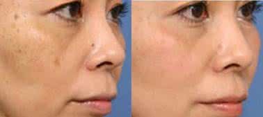 脸上长斑只需这两招简单又管用,脸上有斑的千万别错过这个方法