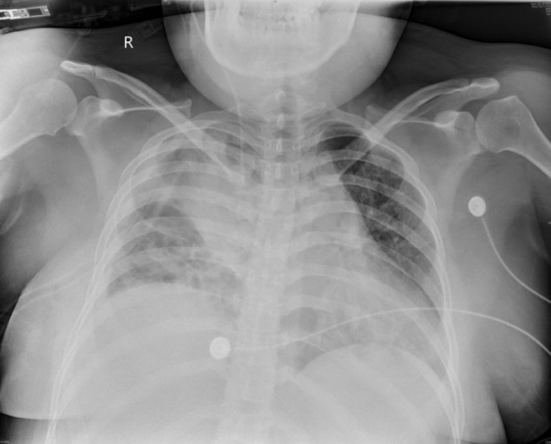 女性气胸的十大症状,女性气胸的十个表现