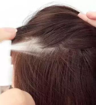 发际线后移的头发还能长出来么,头发发际线高还能长出来吗