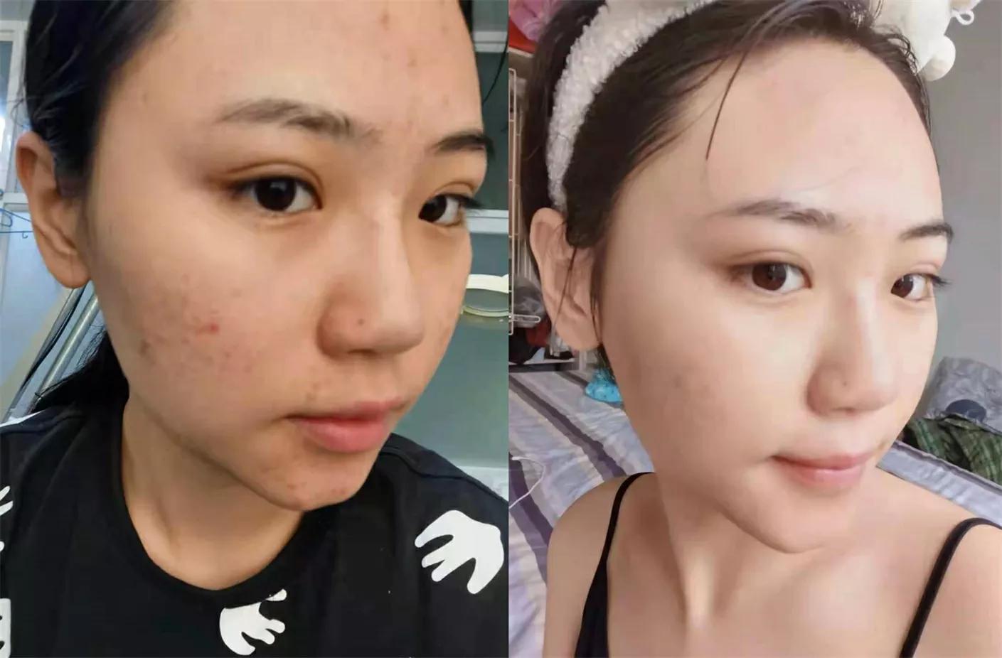 北京看痘痘好的皮肤科医院,去皮肤科看痘痘好不好