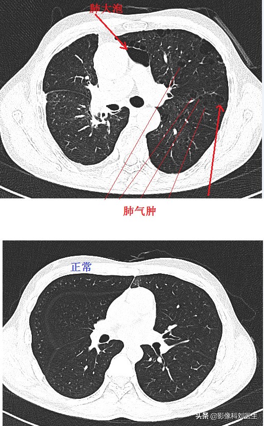 肺气肿治疗权威专家,老年人肺部疾病有哪些