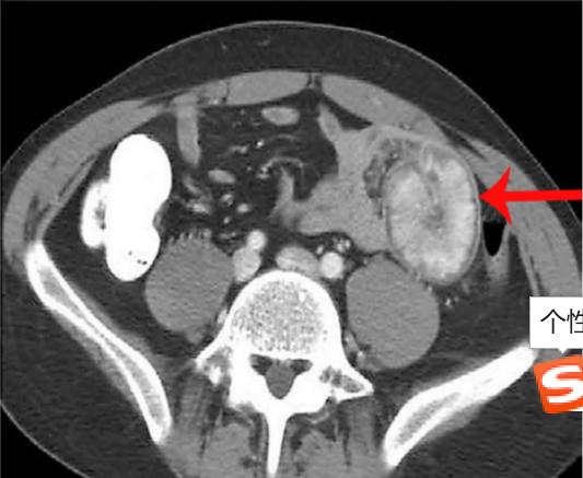 便血可触及腹部包块,肠套叠肚子轻微疼痛