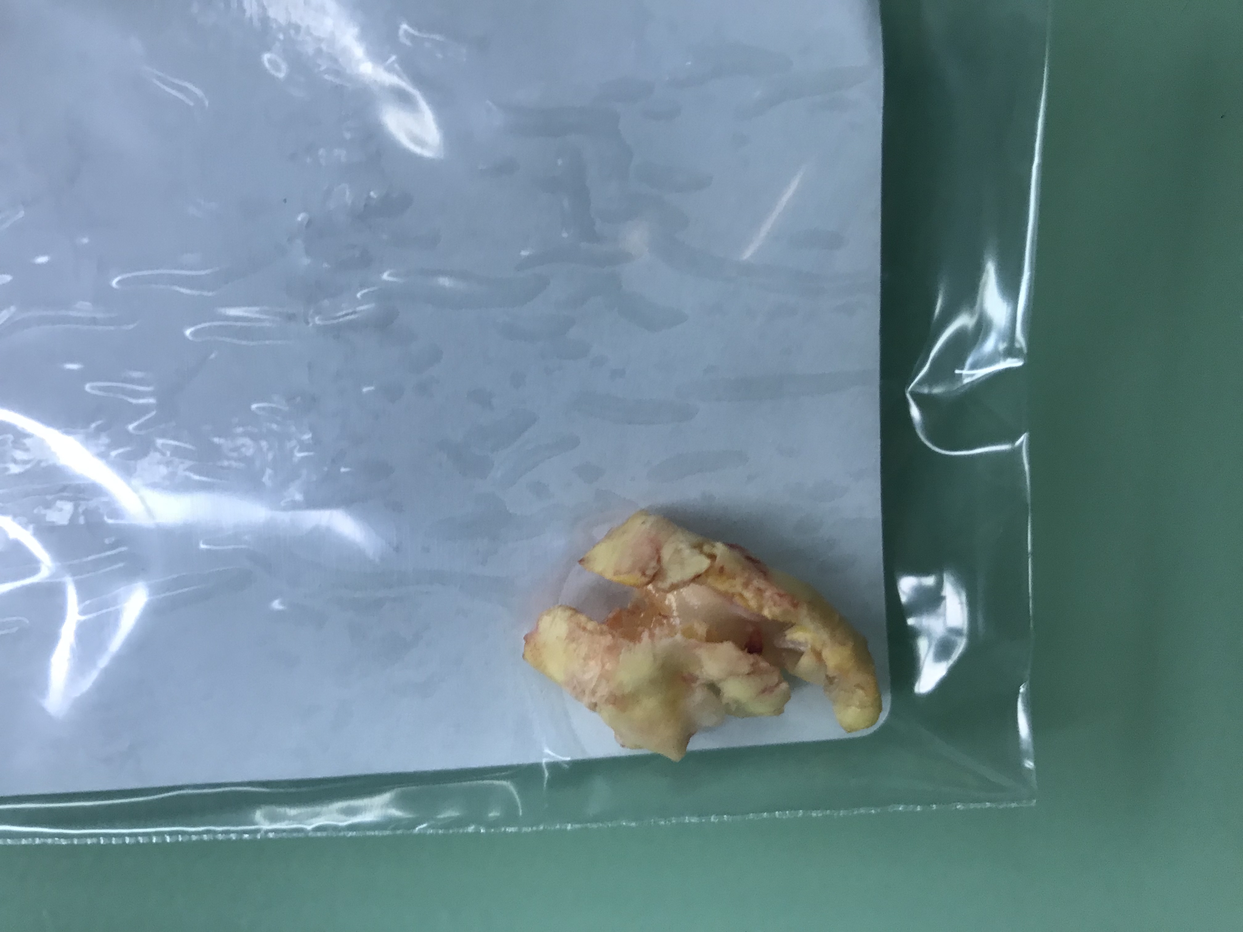 颈动脉斑块大到什么程度需要手术，告诉你大实话