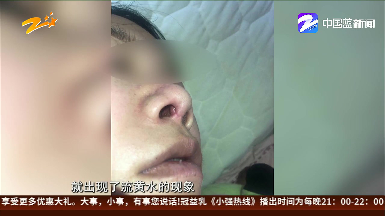 女子做鼻综合手术,莫名其妙鼻子流出黄色液体,这事到底怪医院还是怪她?