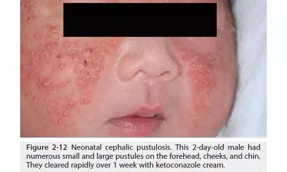 新生儿皮肤问题大全一览表,新生儿常见八大皮肤问题