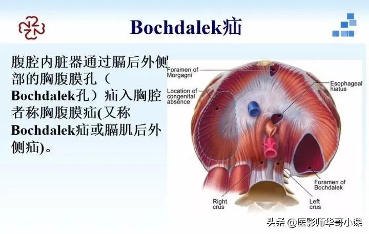 「精品课件」胸部膈肌的解剖及常见病变影像的表现