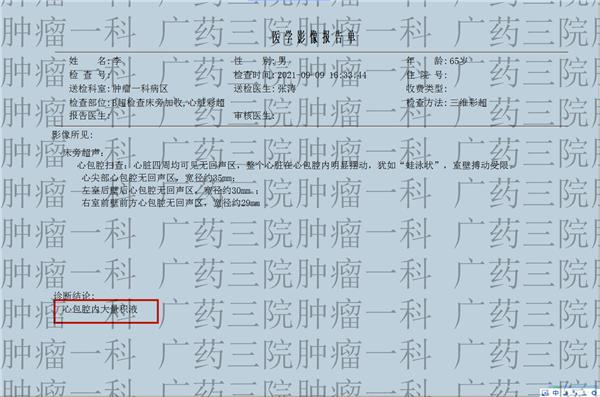 广药三院肿瘤一科丨肺癌心包积液能活多久