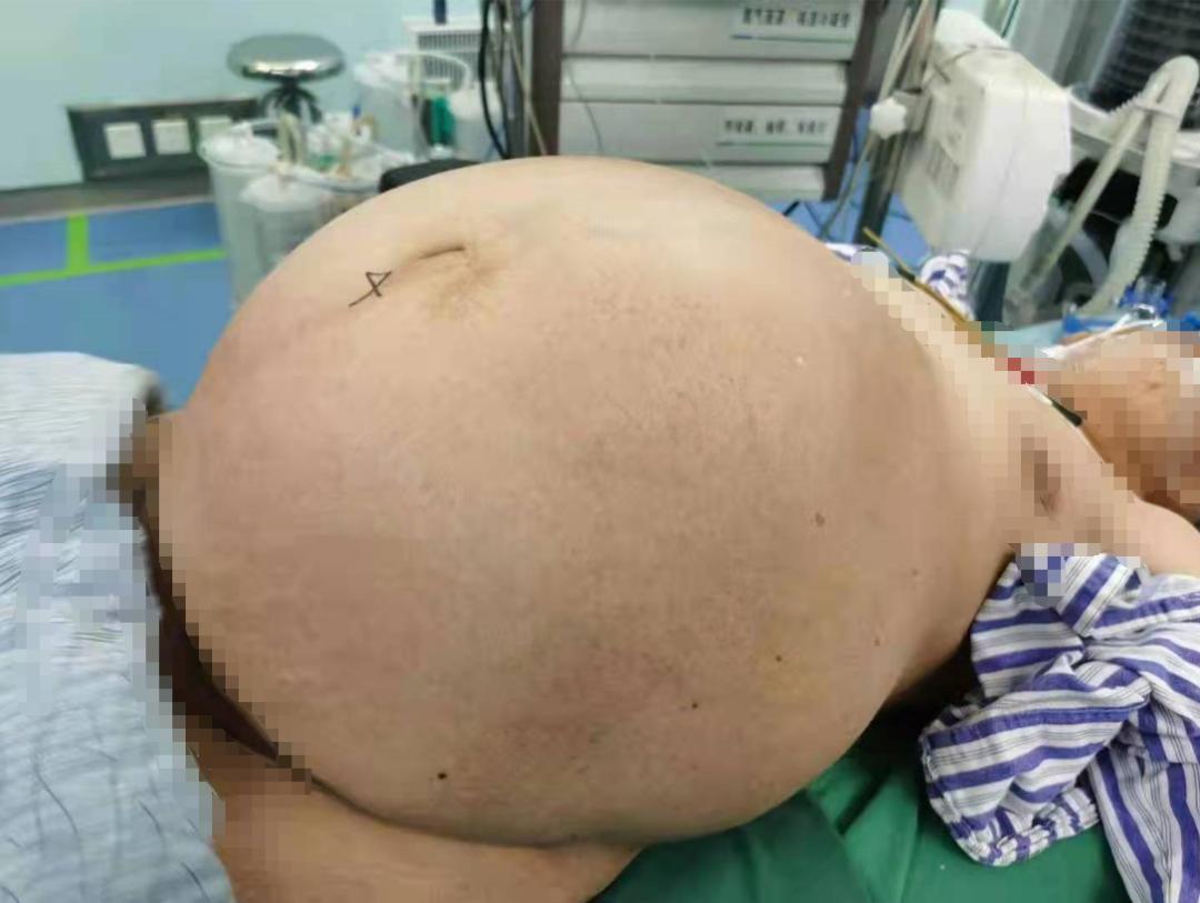 91岁老奶奶腹中35斤巨大肿瘤在株洲市中心医院妇科成功摘除
