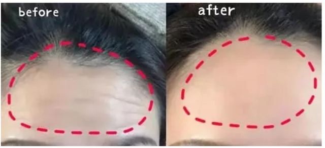 杨紫近照曝光无修图法令纹很深,杨紫面部填充法令纹