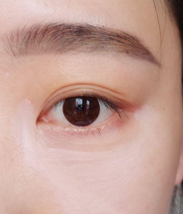 血管型黑眼圈怎么消除,戴眼镜黑眼圈怎么消除