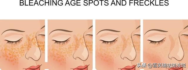 如何快速祛斑最有效的方法,脸上祛斑方法教你如何轻松祛斑