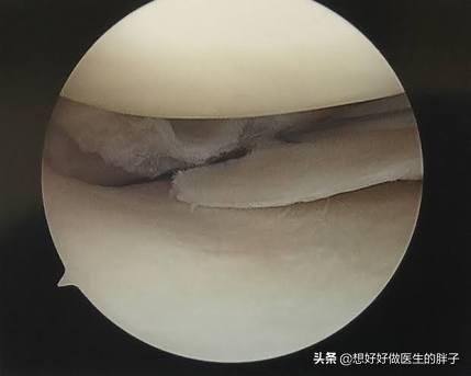 走走路膝盖就软一下怎么回事,走路时一条腿软摔倒怎么回事