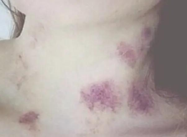 宝妈满脖子“草莓”去接孩子放学，被大娘追问是不是上火