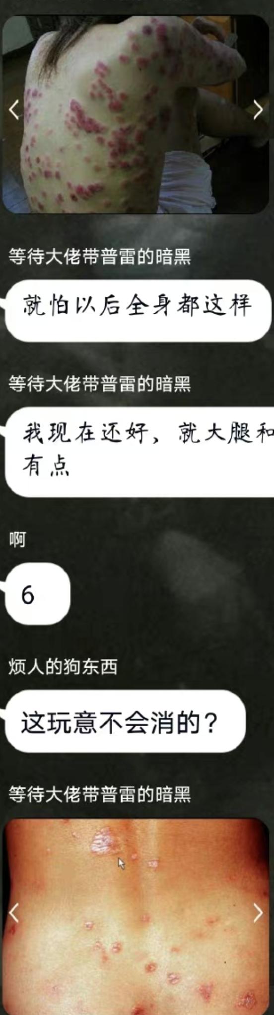 聊天记录爆出真实的人间，老公说工作太累了长湿疹，其实是梅毒