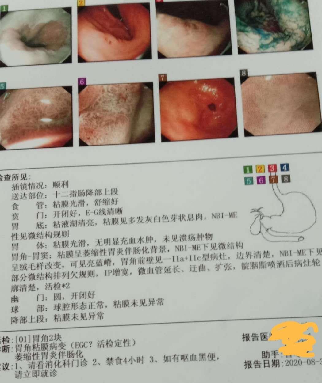 胃镜检查早癌怎么治疗,一年一次胃镜能发现早期癌吗