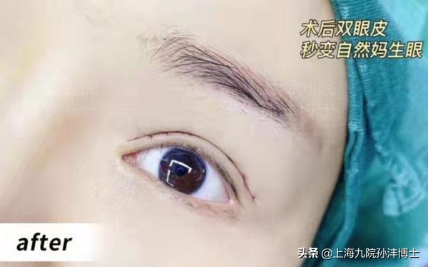 19岁全切双眼皮恢复图真实,眼修复手术