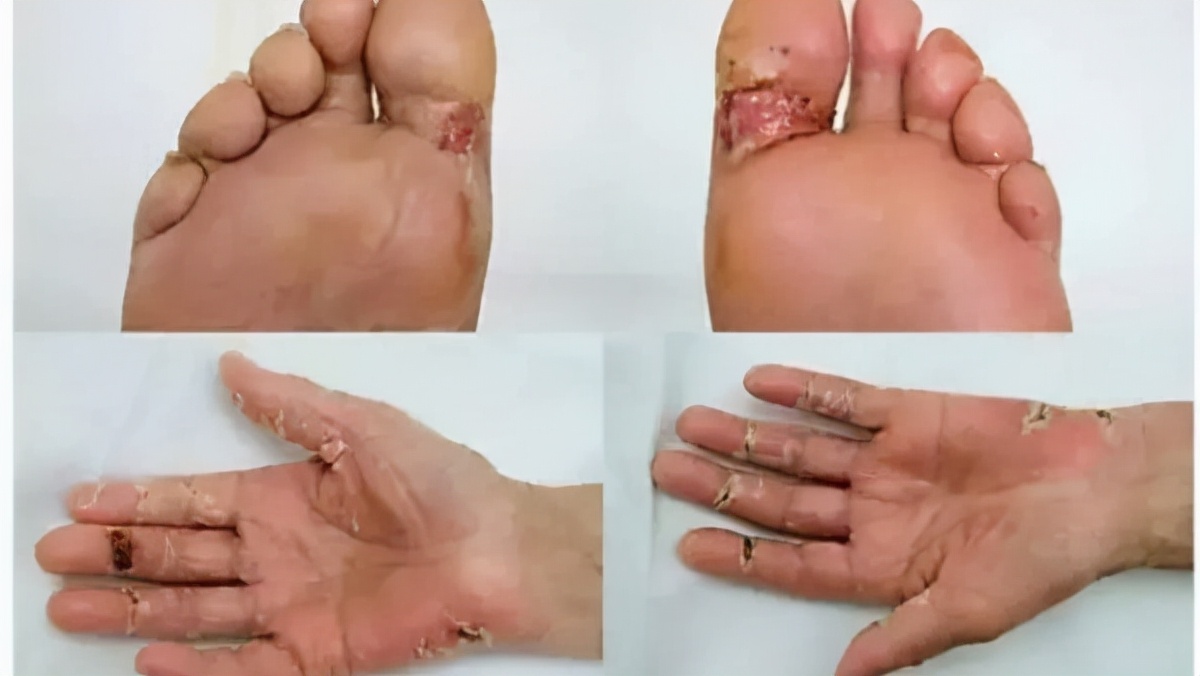 靶向药物引起腹泻中医治疗,靶向药所致腹泻