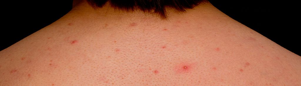 前胸后背为什么会长痘痘?如何预防?一文帮你搞定