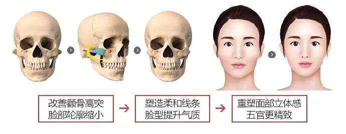 韦敏颧骨手术怎么样,如何判断高颧骨和颧弓外扩