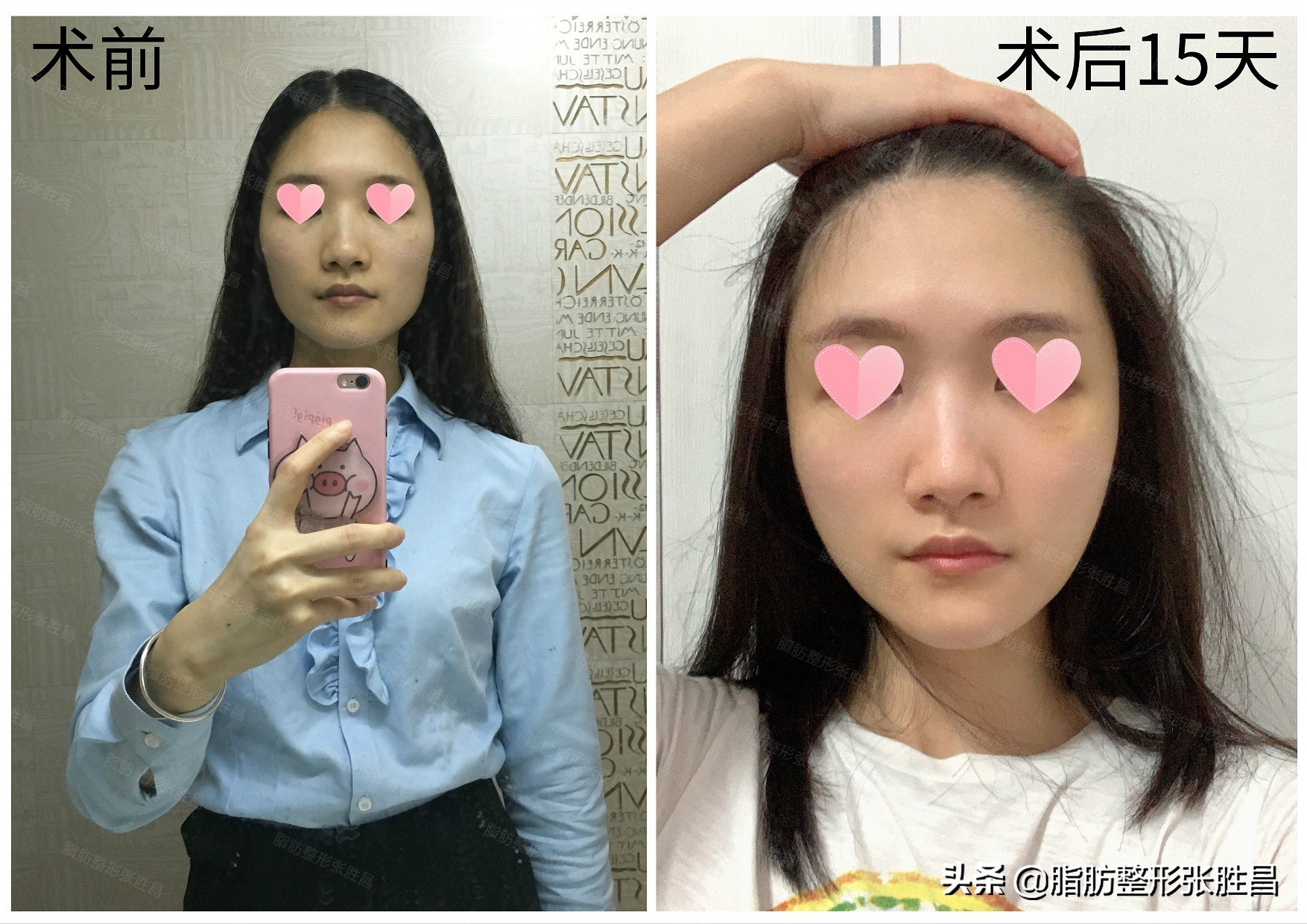 面部特别凹陷的人命运,面部凹陷超显老