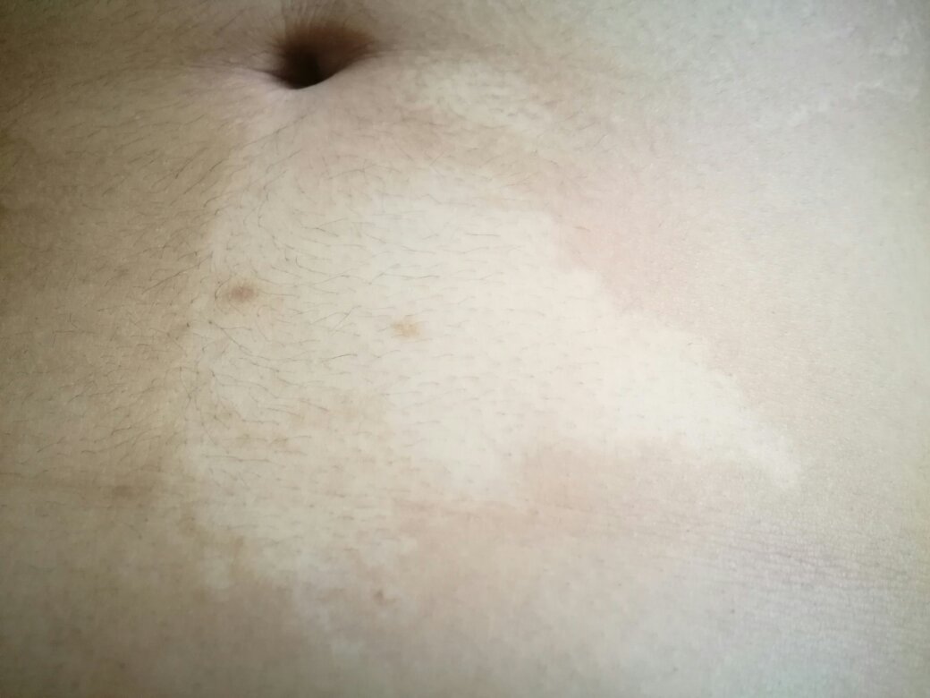 小孩怎么区分白斑和白癜风,如何辨别白斑和白癜风区别