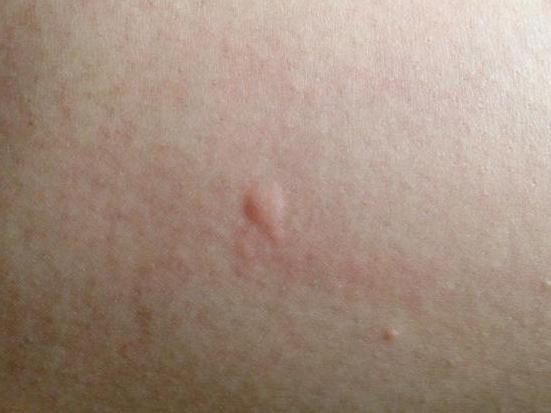 被蚊子咬了怎么办最有效的方法,被蚊子咬了怎么有快速的解决方法