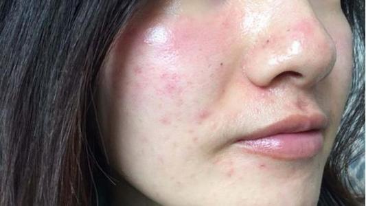 激素脸好难受,激素脸痒的难耐怎么办