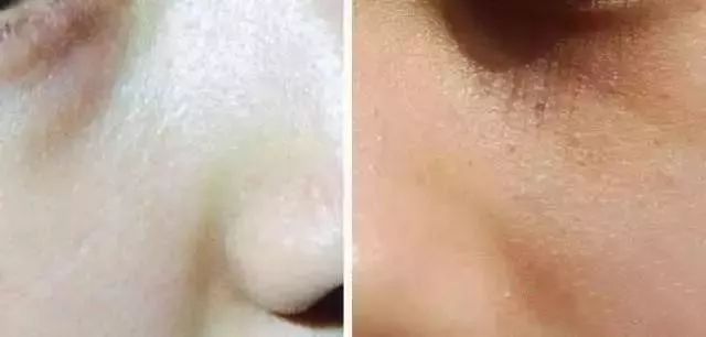 鼻梁和眼睛旁边的小颗粒有救了,鼻梁旁边有小颗粒怎么处理