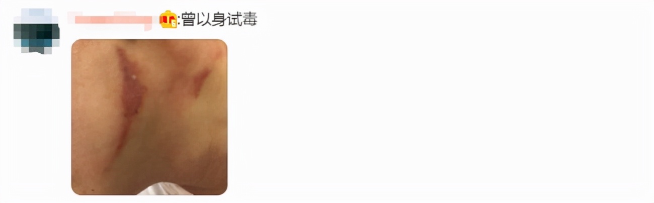 40岁女人脸被隐翅虫烧伤毁容吗,隐翅虫碰到脸上了是不是会毁容