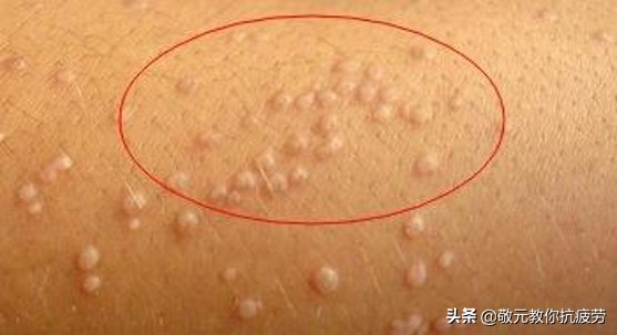 长疣怎么预防,丝线疣怎么预防