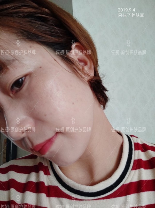 生完孩子烂脸,生完孩子脸上垮了怎样处理