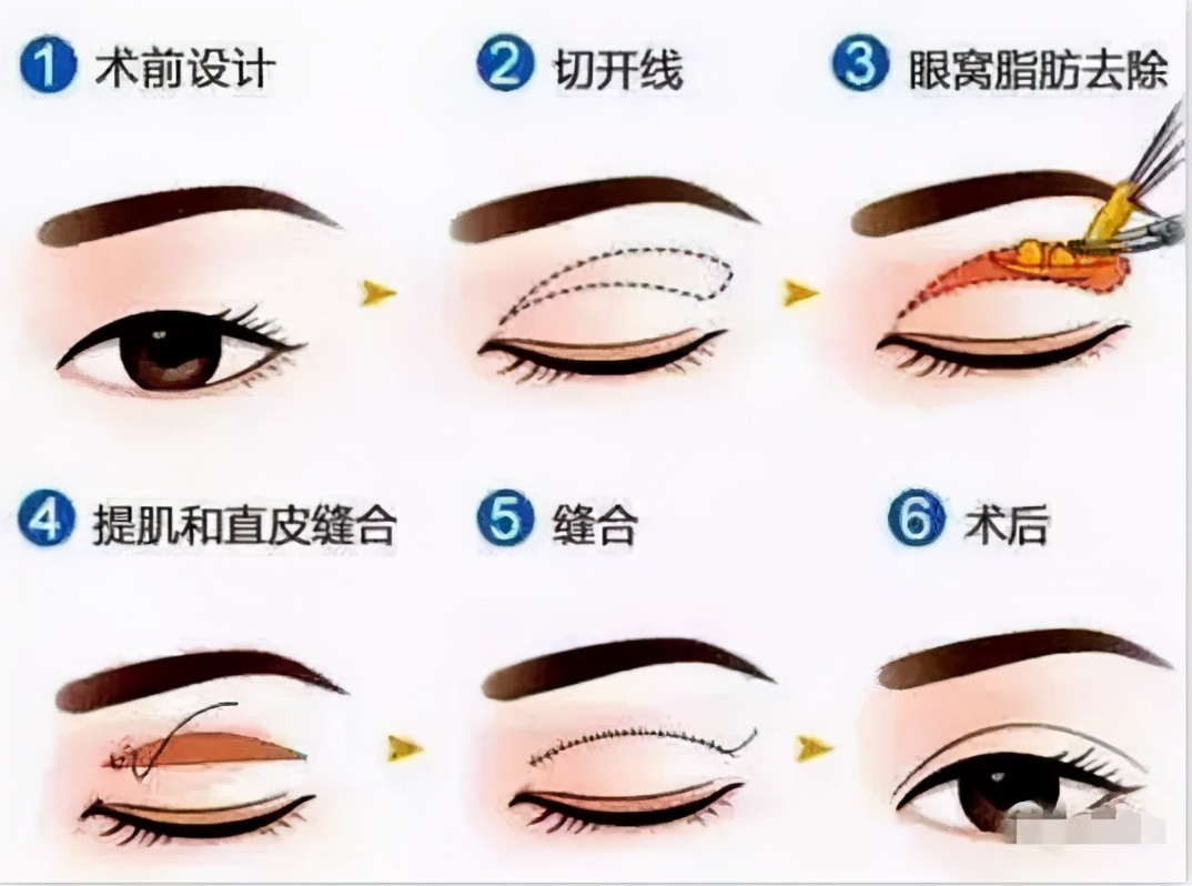 割双眼皮后变单眼皮,微创双眼皮恢复变三眼皮