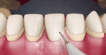 牙科治疗牙龈炎的效果怎么样,Helen齿科中心