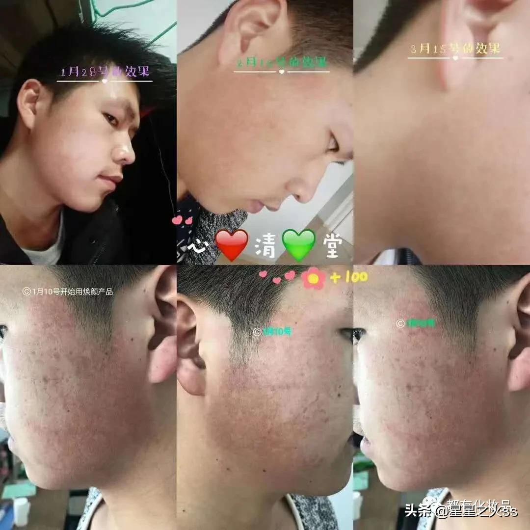 心清堂护肤品祛痘修复,兰树心清堂祛痘效果