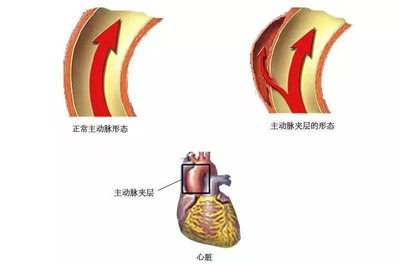 胸痛中心最常见的三种病,胸痛的四大杀手分别是什么