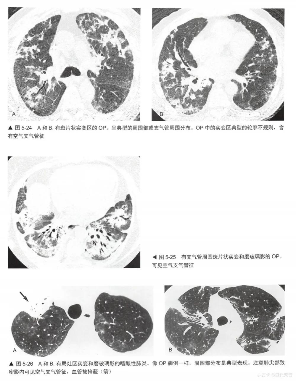 肺hrct诊断思路,肺部hrct检查呈阳性
