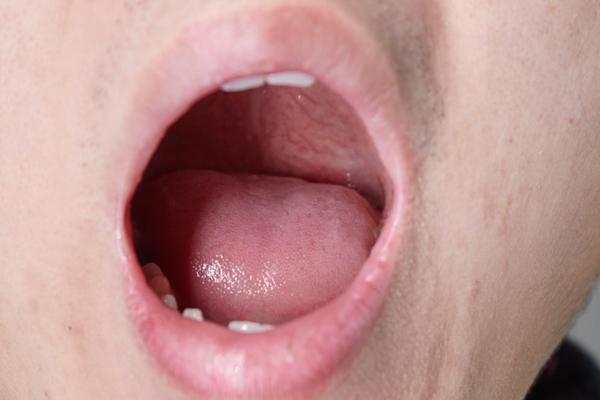 舌头中间有一小片发黑,舌头中间发黑要不要紧