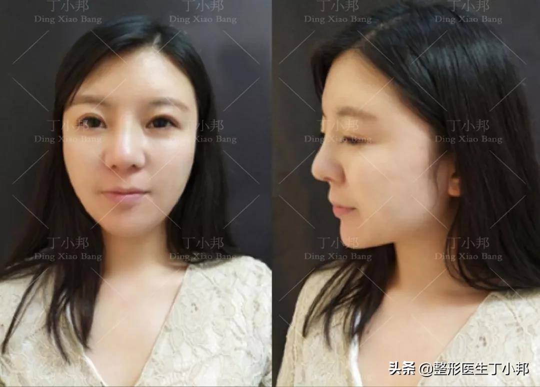 全脸填充脂肪饱满一点好不好看,脂肪填充太饱满怎么样消除