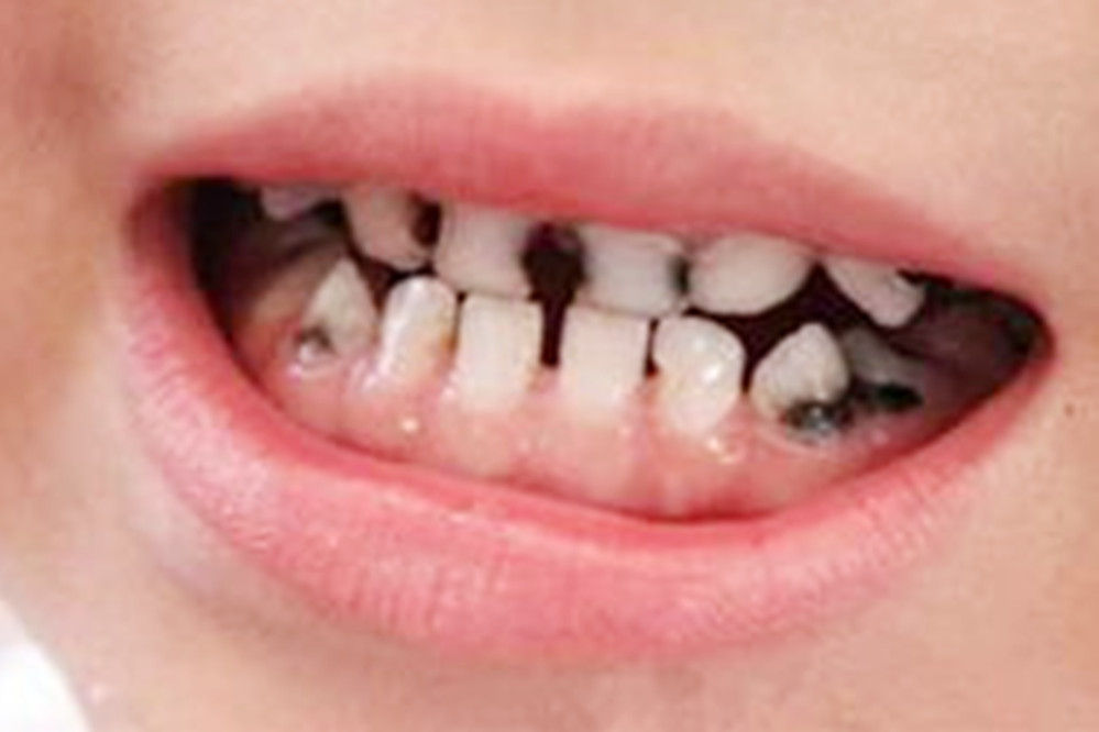 宝宝牙齿表面被腐蚀图片,宝宝牙齿发黑被腐蚀