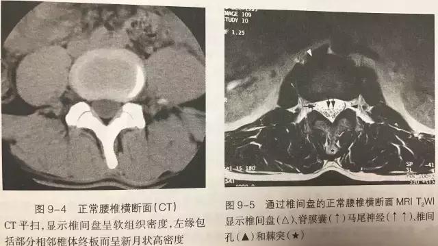 腰椎间盘突出的正确认识,腰椎间盘突出十大禁忌运动