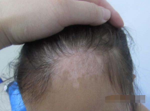 儿童白癜风发展期应该怎样控制,白癜风治愈患者分享痊愈经验