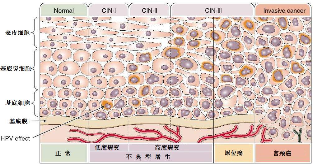 TCT、阴道镜、CIN、锥切(leep)都是什么意思?